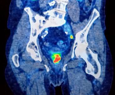 Colin's PET scan.