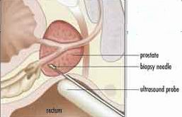 An ultrasonic probe guiding biopsy needles