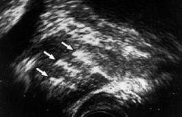 The ultrasonic view of the prostate with needles