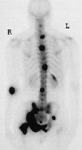 An image of a body (not mine) made using skeletal scintigraphy,