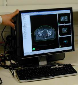 The X-ray scan of the prostate used to plan radiotherapy