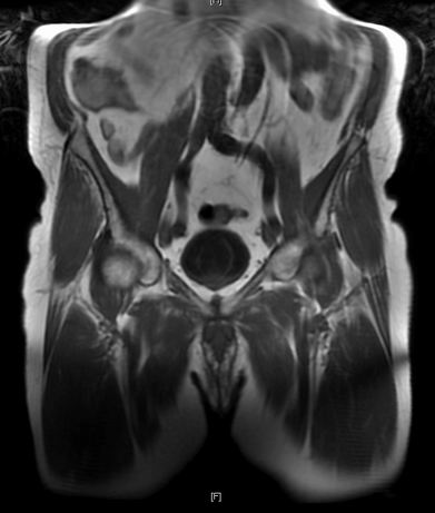 The MRI scan of my pelvis showing the prostate just beneath the circular bladder
