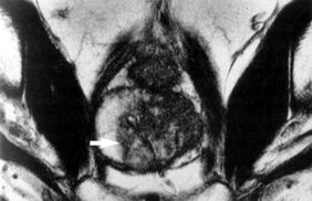 An MRI section through a prostate: the arrow shows cancer