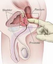 The prostate being examined by a finger